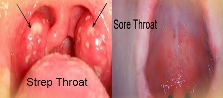 in throat Adult sore