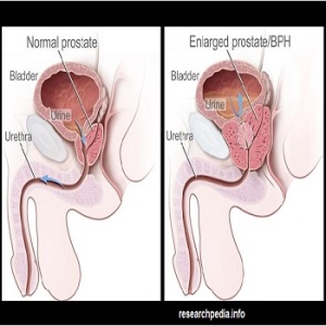 Reasons of Prostate Cancer in Men