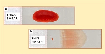 Difference between Thick Blood Smears and Thin Blood Smears