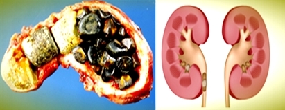 Difference between Gallstones and Kidney Stones