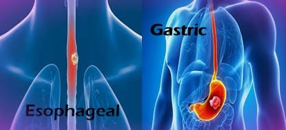 Difference between Esophageal Cancer and Gastric Cancer