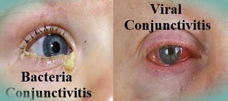 Difference between Bacterial and Viral Conjunctivitis