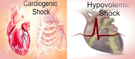 Difference between Cardiogenic and Hypovolemic Shock