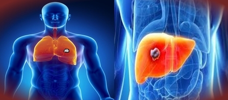 Difference between Lung Abscess and Liver Abscess