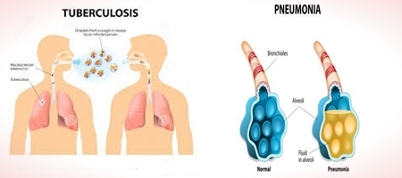 Difference between Tuberculosis and Pneumonia