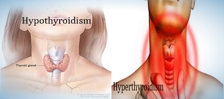 Difference between Hypothyroidism and Hyperthyroidism